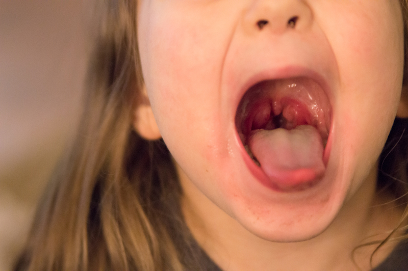 tonsils before getting taken out
